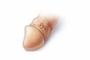 жыныс мүчөсүнүн сода менен кеңейишине каршы көрсөтмөлөр